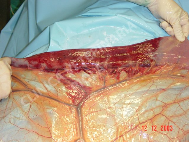 Infarto 3